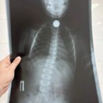 В Балакове хирурги извлекли монету из пищевода двухлетнего ребенка